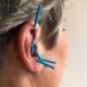5 akupunkturnåle er isat på et øre